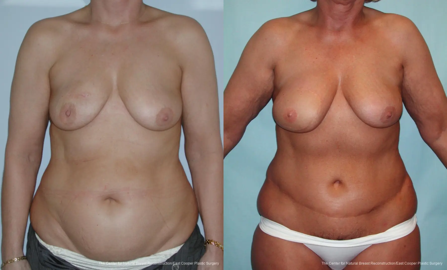 Breast Reconstruction DIEP - Before and After