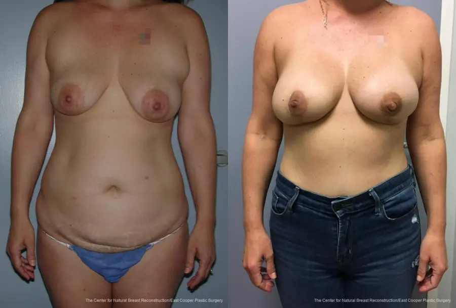 Breast Reconstruction DIEP - Before and After