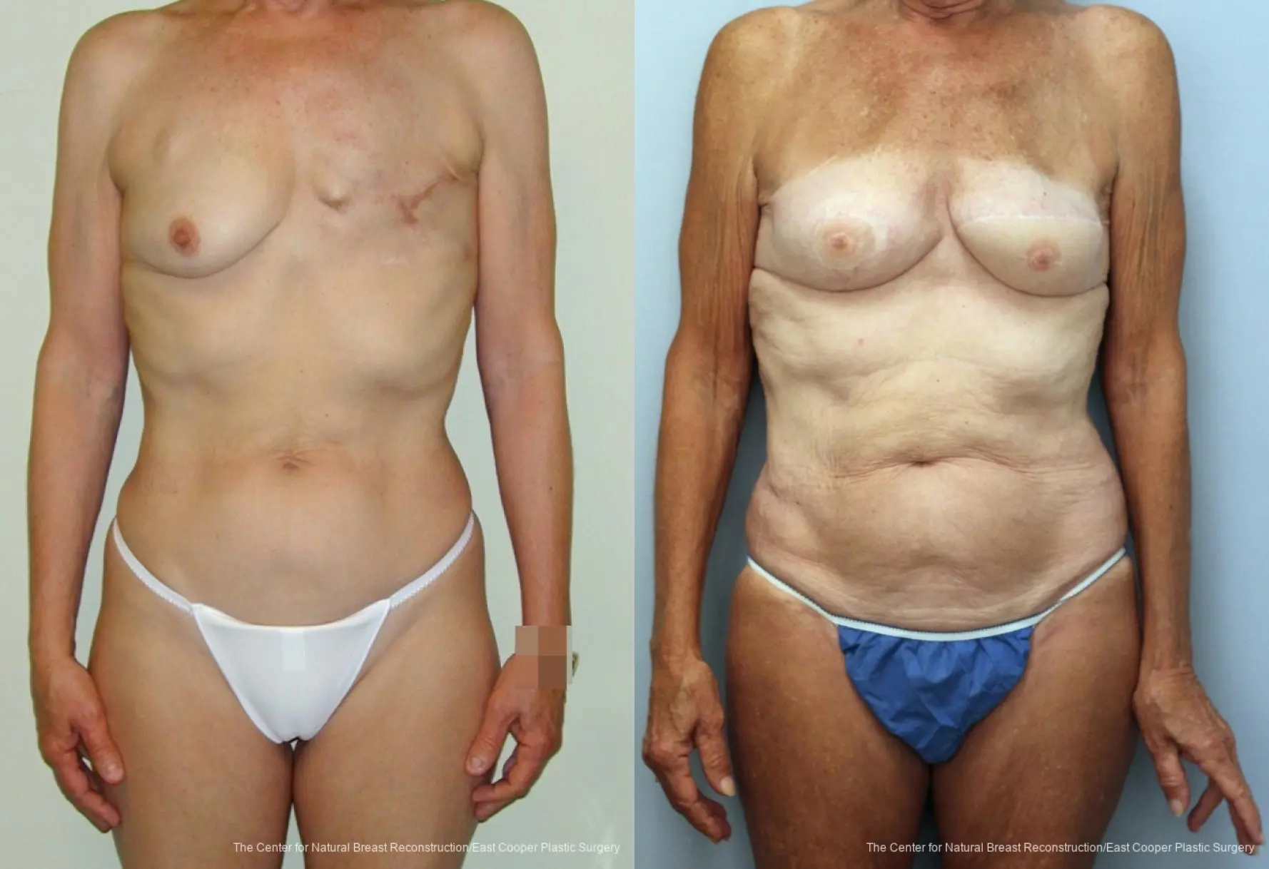 Breast Reconstruction GAP: Patient 8 - Before and After  