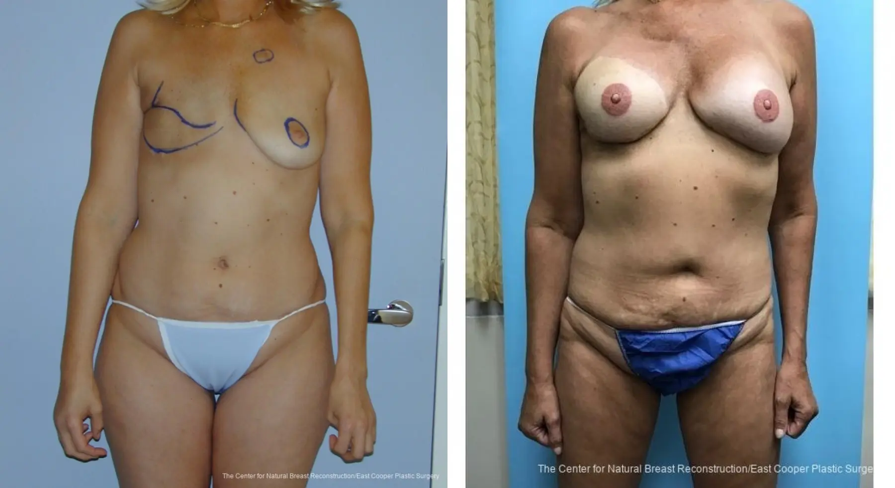 Breast Reconstruction GAP - Before and After 1