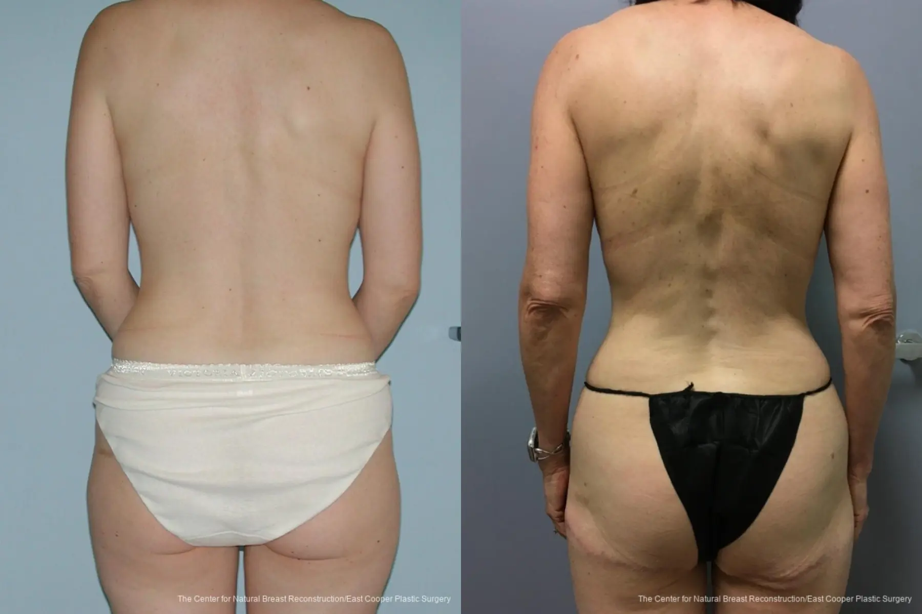 Breast Reconstruction GAP: Patient 10 - Before and After 2