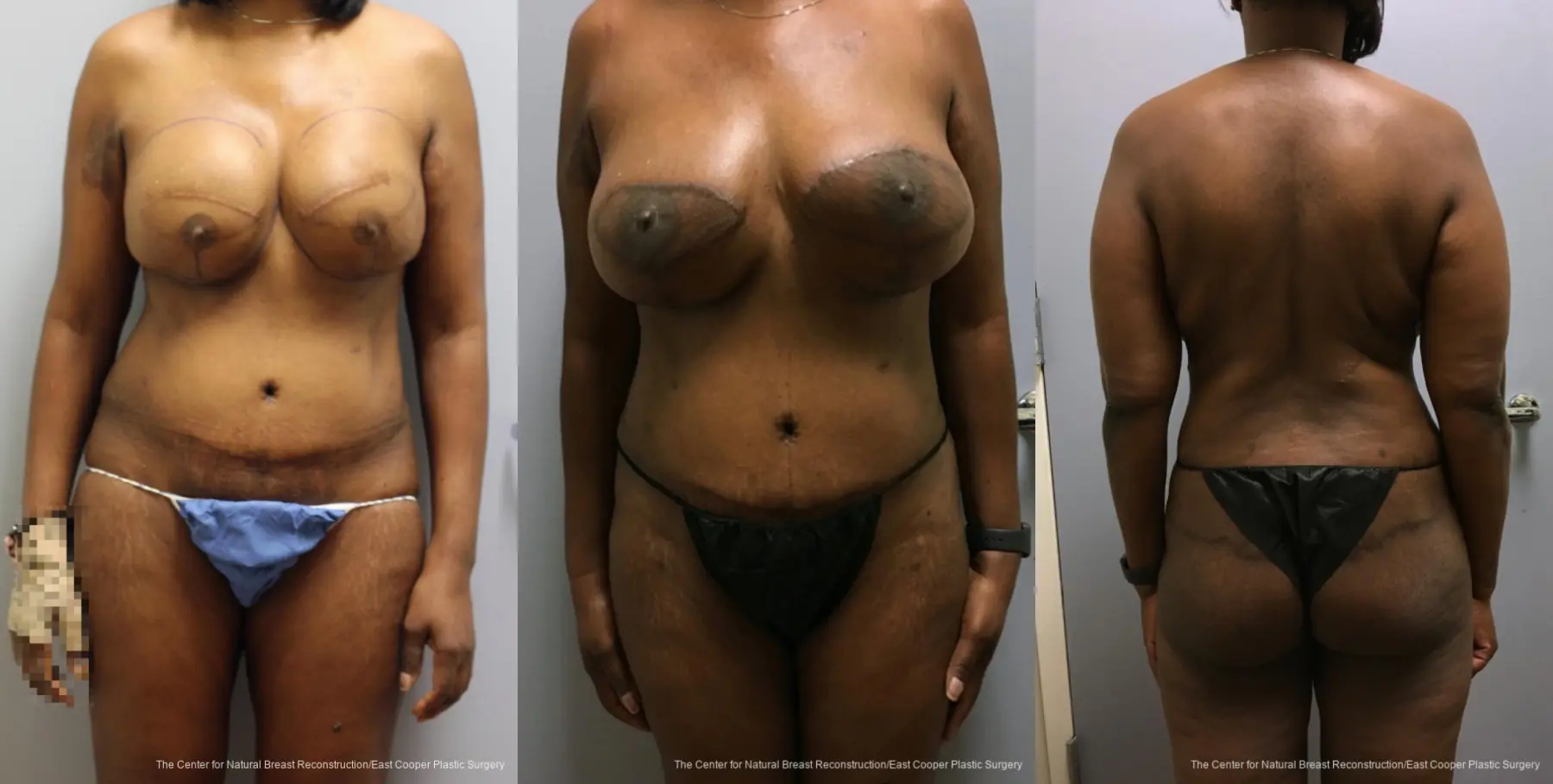 Breast Reconstruction GAP - Before and After 1