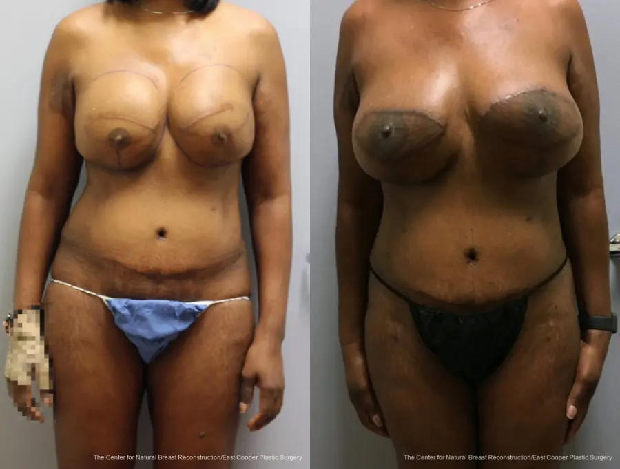 Breast Reconstruction GAP - Before and After