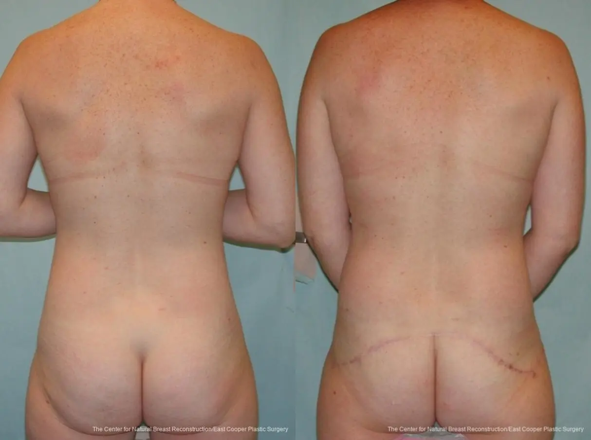 Breast Reconstruction GAP - Before and After 2