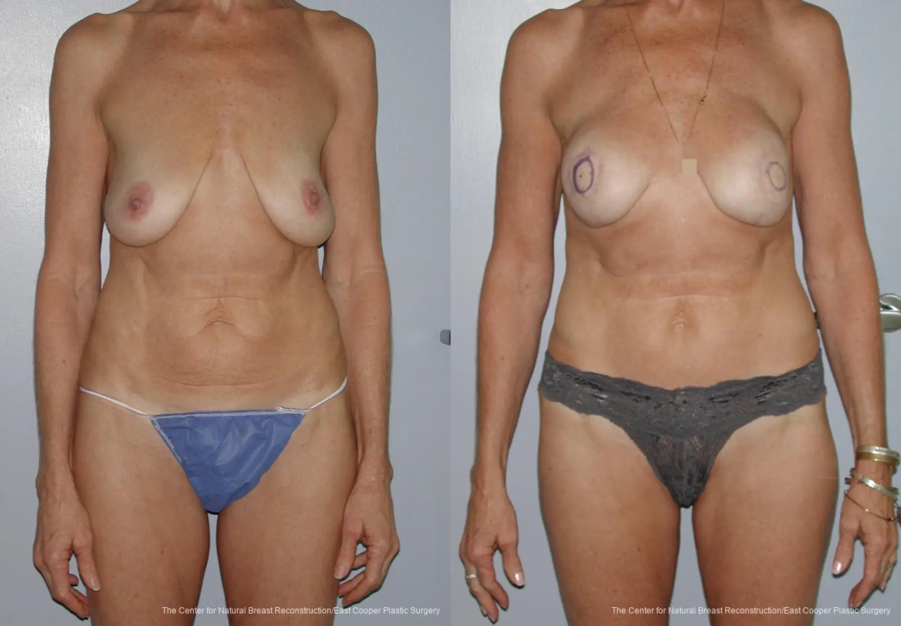 Breast Reconstruction GAP: Patient 9 - Before and After 1