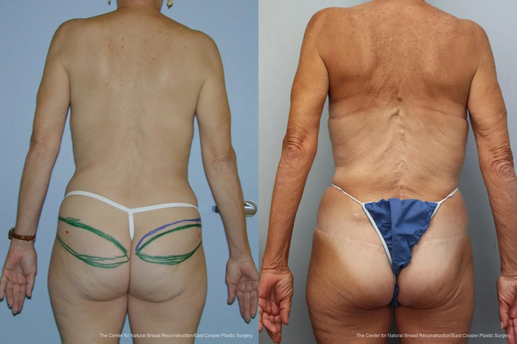 Breast Reconstruction GAP: Patient 8 - Before and After 2