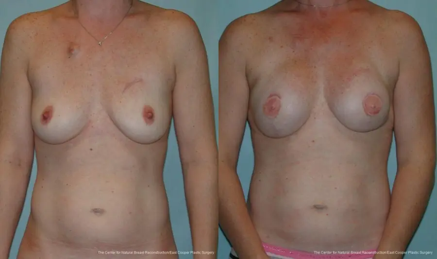 Breast Reconstruction GAP - Before and After