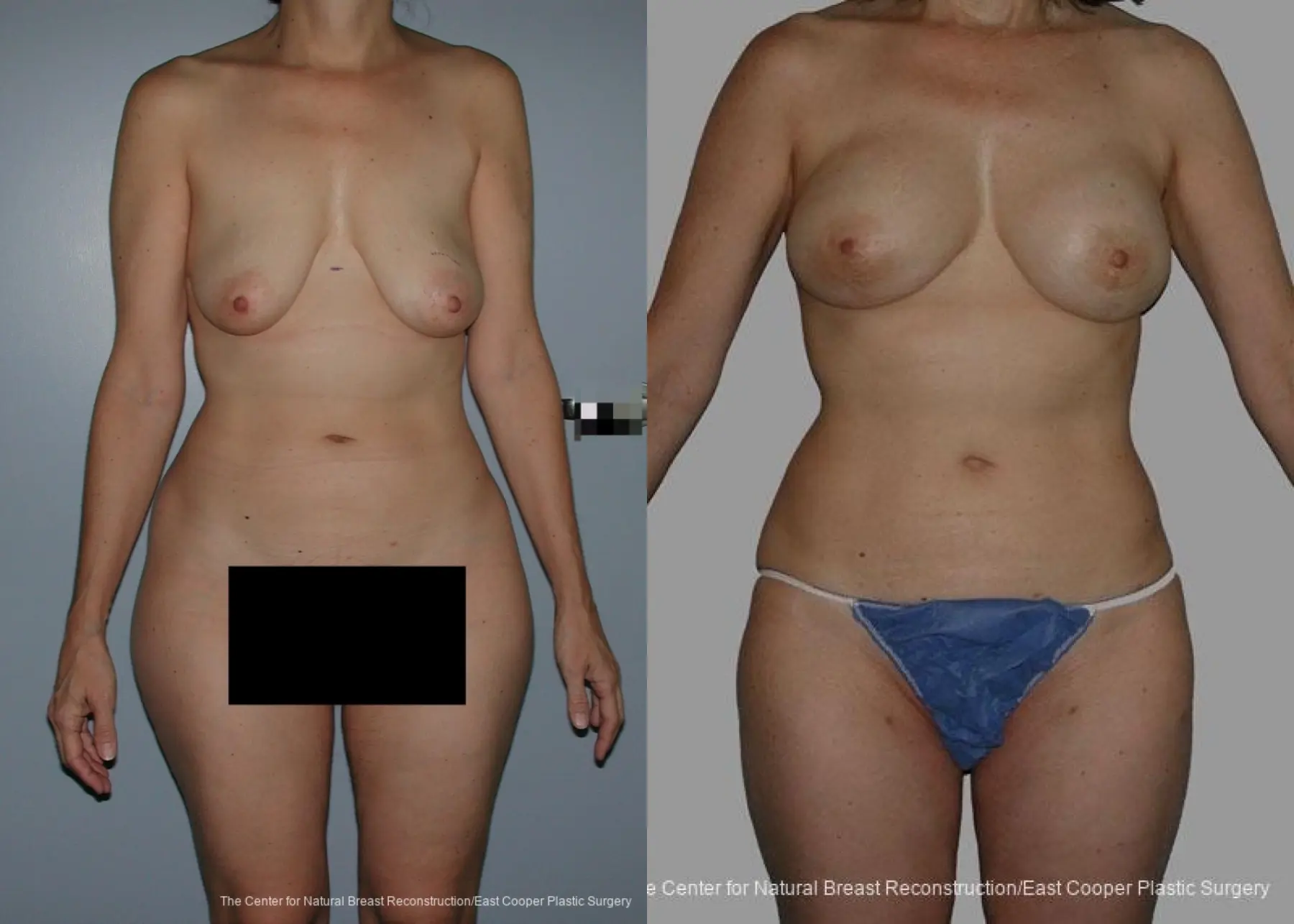 Breast Reconstruction GAP - Before and After