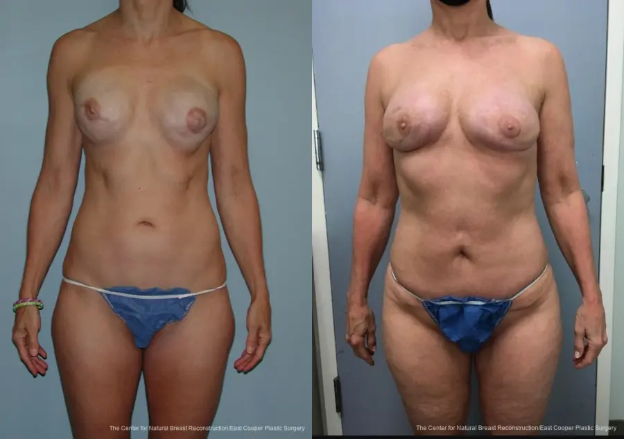 Breast Reconstruction GAP - Before and After
