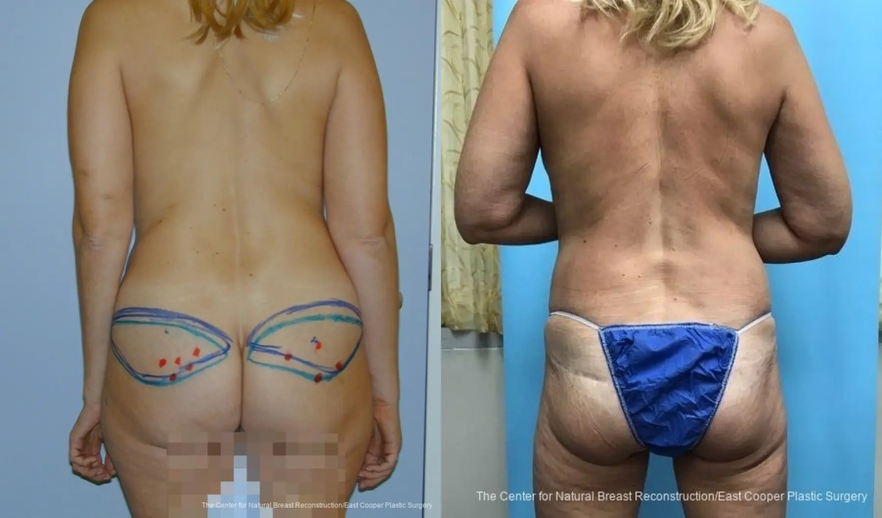 Breast Reconstruction GAP - Before and After 2