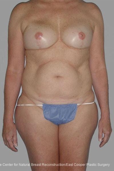 Breast Reconstruction GAP: Patient 7 - Before 