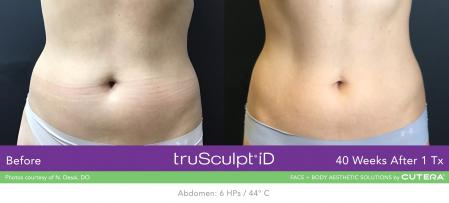 TruSculptiD: Patient 7 - Before 