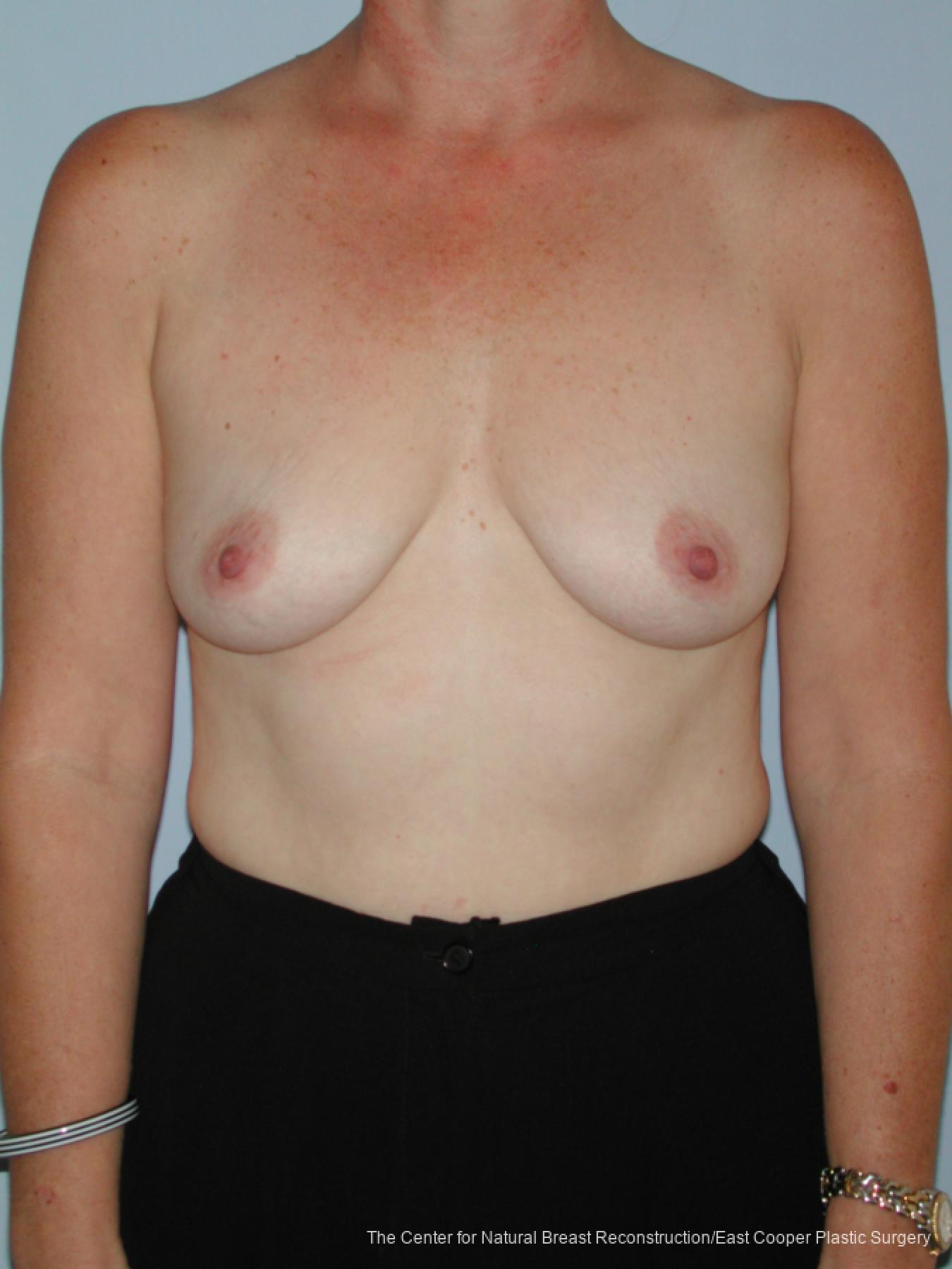 Breast Augmentation: Patient 4 - Before 