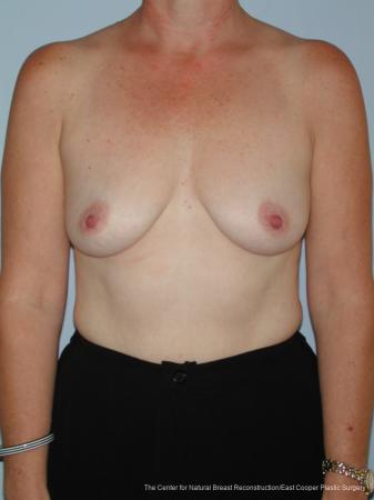 Breast Augmentation: Patient 4 - Before 