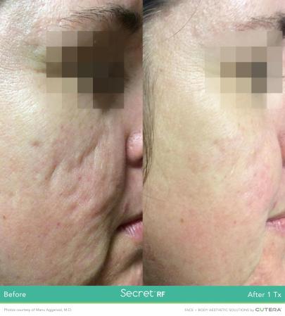 Secret RF: Patient 6 - Before 