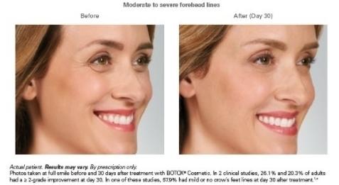 BOTOX® Cosmetic: Patient 2 - After 1