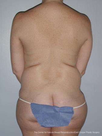 Breast Reconstruction GAP: Patient 7 - After  