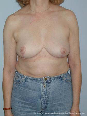 Breast Reduction: Patient 5 - After  