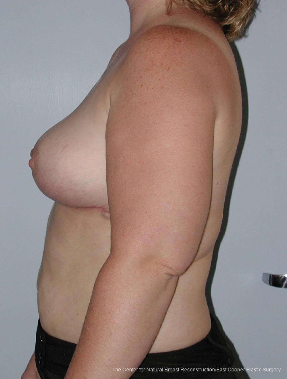 Breast Reduction: Patient 7 - After 2