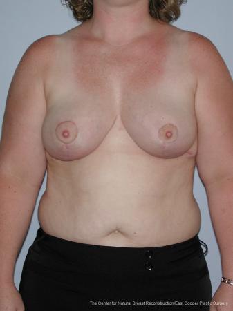 Breast Reduction: Patient 7 - After  