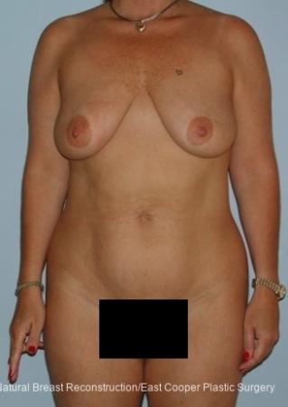 Mommy Makeover: Patient 6 - Before 