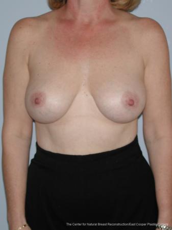 Breast Augmentation: Patient 4 - After  