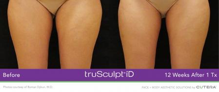 TruSculptiD: Patient 8 - After  