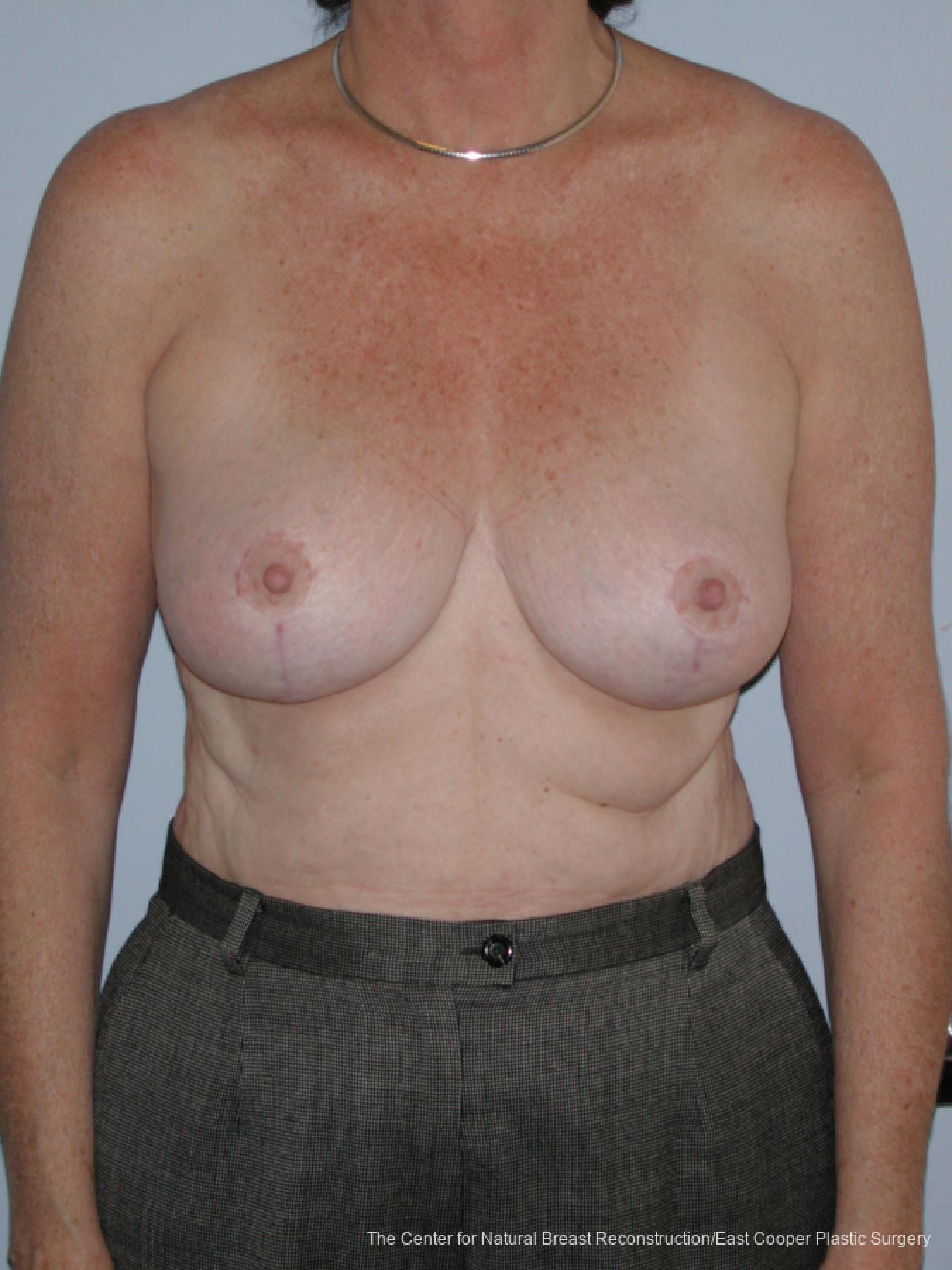 Breast Reduction: Patient 6 - After 1