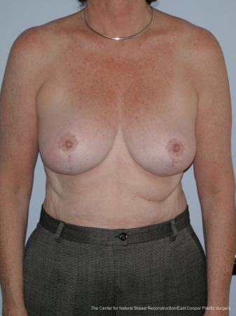 Breast Reduction: Patient 6 - After  