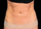 EMSCULPT®: Patient 1 - After 