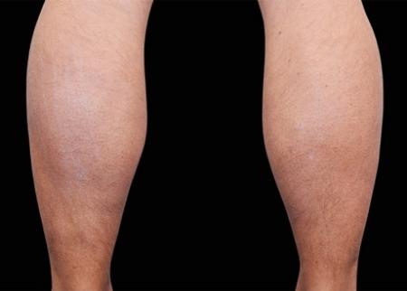 EMSCULPT®: Patient 22 - Before Image 1