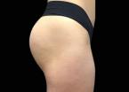 EMSCULPT®: Patient 2 - After 
