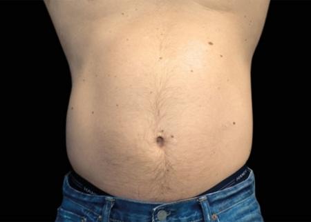 EMSCULPT®: Patient 19 - Before Image 1