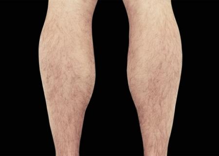 EMSCULPT®: Patient 14 - Before Image 1