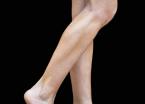 EMSCULPT®: Patient 10 - After 