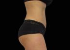 EMSCULPT®: Patient 4 - After 