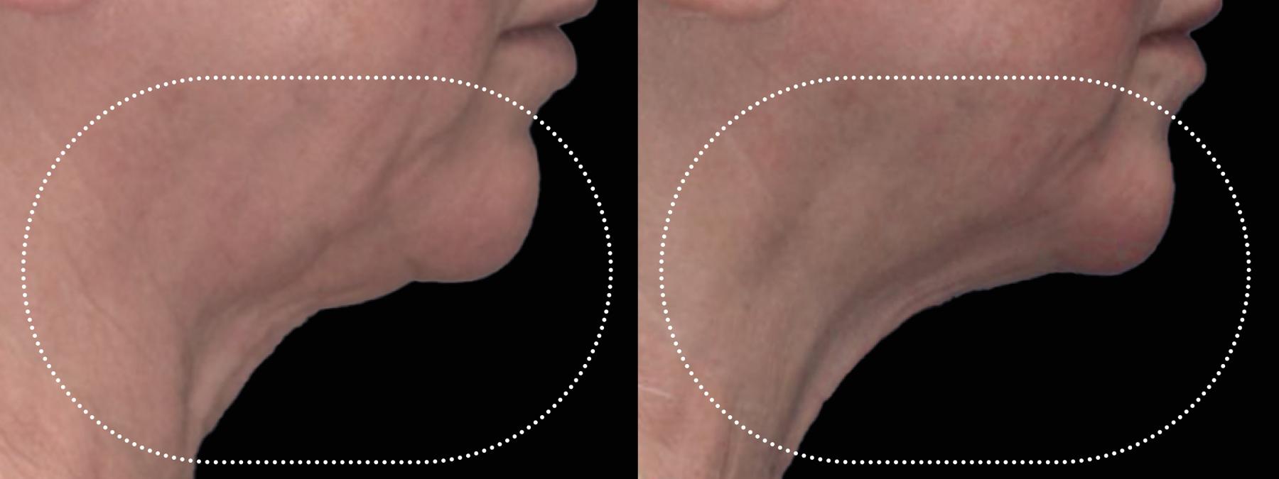 EMFACE™: Patient 6 - Before and After  