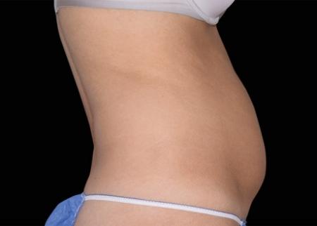 EMSCULPT®: Patient 21 - Before Image 1