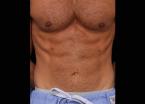 EMSCULPT®: Patient 5 - After 