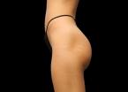 EMSCULPT®: Patient 6 - After 