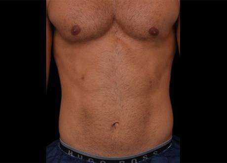 EMSCULPT®: Patient 5 - Before 1