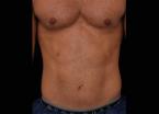 EMSCULPT®: Patient 5 - Before 