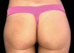 EMSCULPT®: Patient 8 - Before 