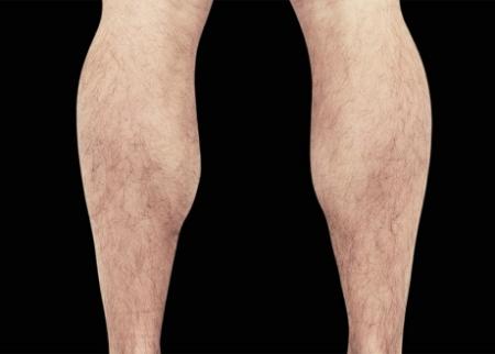 EMSCULPT®: Patient 14 - After Image 1