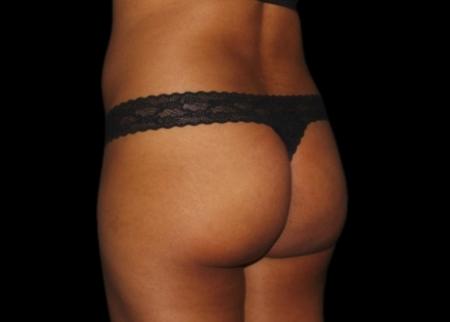EMSCULPT®: Patient 17 - Before Image 1