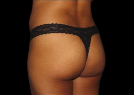 EMSCULPT®: Patient 17 - After Image 1