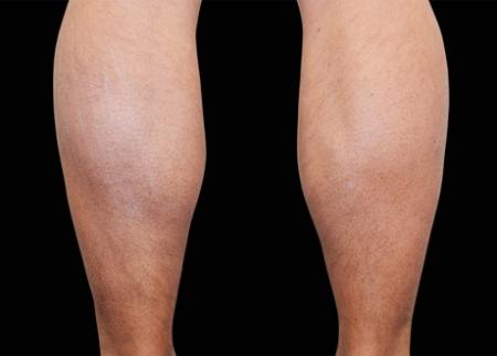 EMSCULPT®: Patient 22 - After Image 1