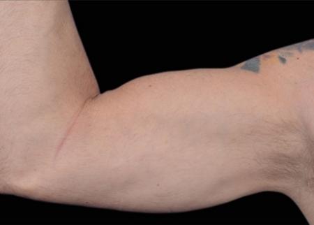 EMSCULPT®: Patient 12 - Before Image 1