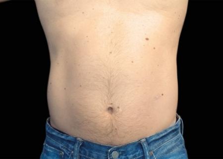 EMSCULPT®: Patient 19 - After Image 1