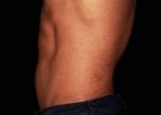 EMSCULPT®: Patient 3 - After 